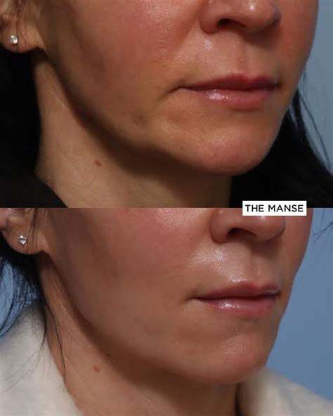 Dermal Filler for Jowls and Marionette Folds - Best Cosmetic Clinic ...