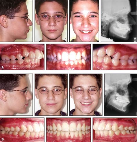 Long-Term Stability of Twin Force Bite Corrector in 5 Patients