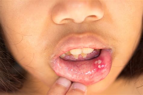 Gingivostomatitis in Children: What You Should Know