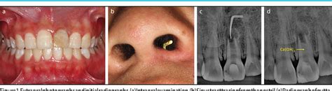 Figure 1 from Endodontic Management of a Chronic Periapical Abscess in ...