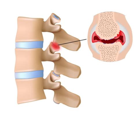 Facet Hypertrophy Symptoms, Diagnosis, Treatment | AllSpine