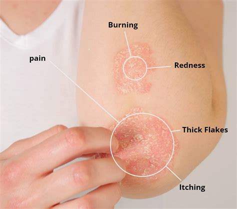 Psoriasis Treatment - The Dermatology Office