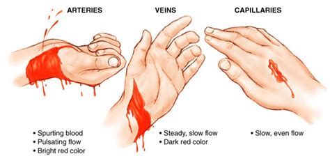 Different Types of Bleeding First Aid – First aid for free