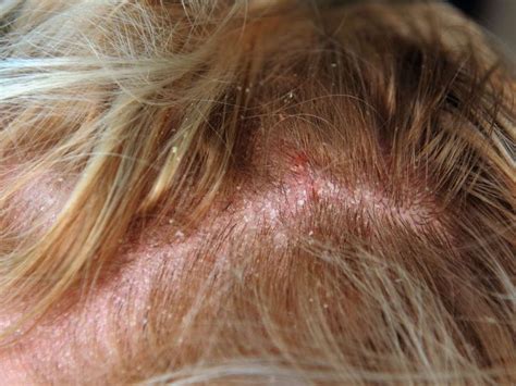 Yeast Infection on Scalp: Expert Review of Causes, Symptoms and Treatment