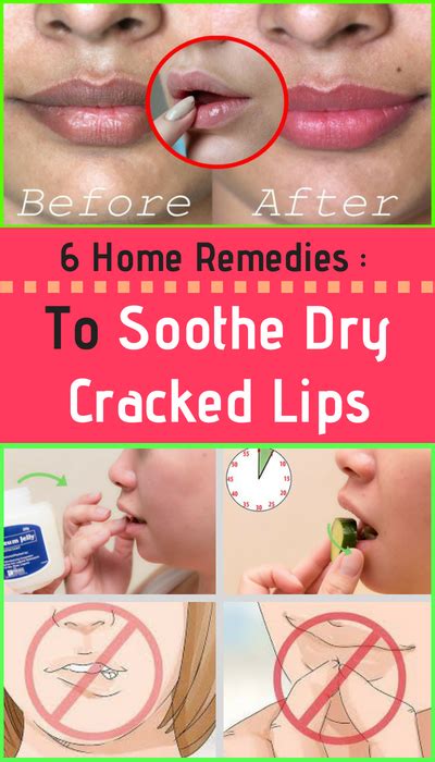 Here Are 6 Home Remedies To Soothe Dry Cracked Lips – Healthy National ...