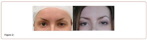 Facial Nerve Paresis Functional and Aesthetic Improvement with Min ...