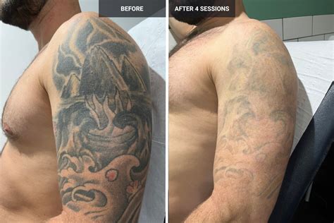 Transformations Unveiled Laser Tattoo Removal Before and After