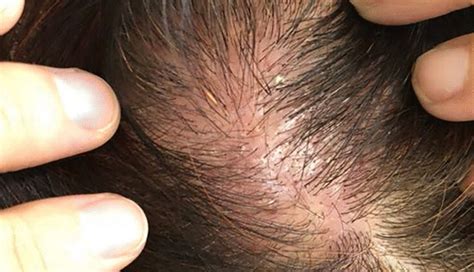 How To Treat Scabs On The Scalp - lifeberrys.com