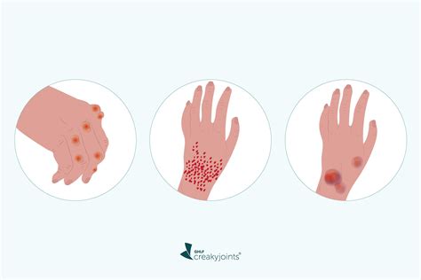 Rheumatoid Arthritis and Skin Problems: What You Need to Know