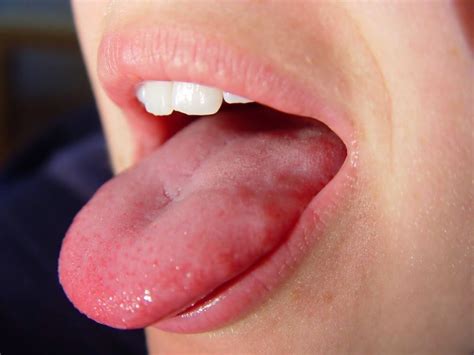 5 Early Symptoms Of Tongue Cancer - ebuddynews