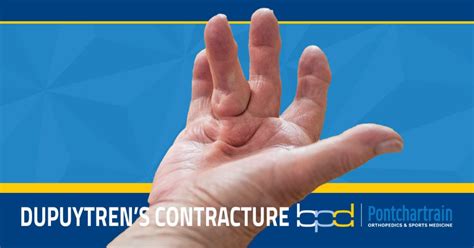 Understanding Dupuytren’s Contractures - Brandon P. Donnelly, MD