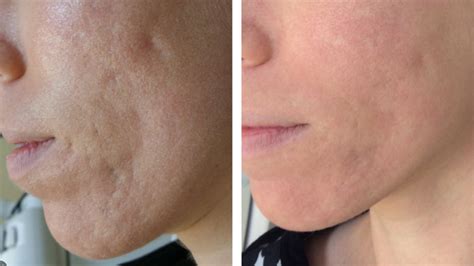 Acne Scar Treatment Norfolk, VA – Edgewater Aesthetics | The Premier ...