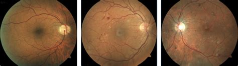 Diabetic Retinopathy | Conditions | Retina Center of Texas