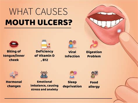 Best Medicine for Mouth Ulcer in India - PlanMyMedical