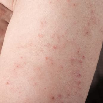 Rashes That Come and Go: 5 Possible Causes and Corresponding Treatments ...