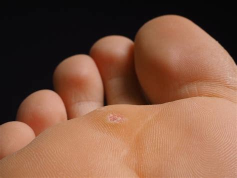 All About Plantar Warts