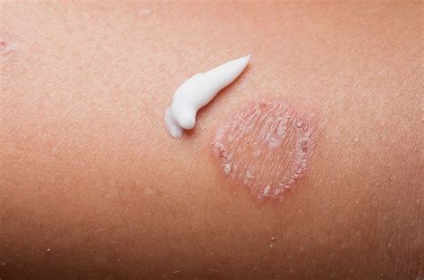 Ringworm — Medical Secrets