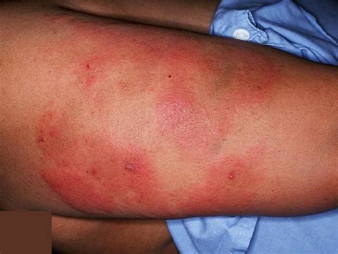 Idiopathic Thrombocytopenic Purpura Rash