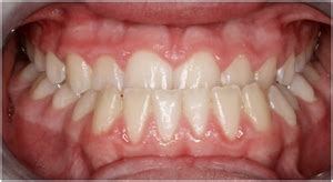 What is anterior crossbite? | News | Dentagama