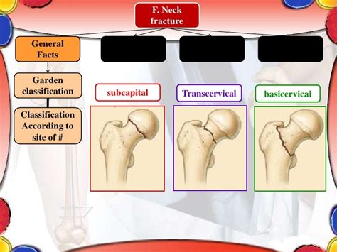 Femoral bone fracture