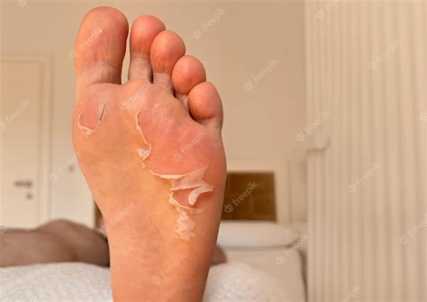 Premium Photo | Skin peels off a foot sweaty athlete foot skin peeling ...