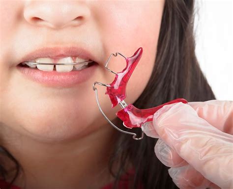 Benefits of Using a Removable Retainer - Vondran Orthodontics