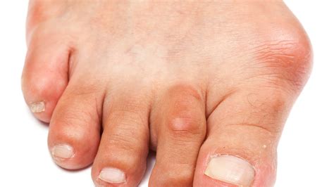 Facts About Bunions You Should Know - Dr Sami - Podiatrist DubaiDr Sami ...