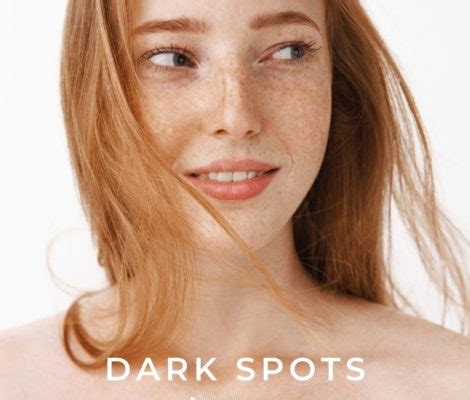 Dark spots on the skin: freckles, solar lentigines, melasma – Healthsprings