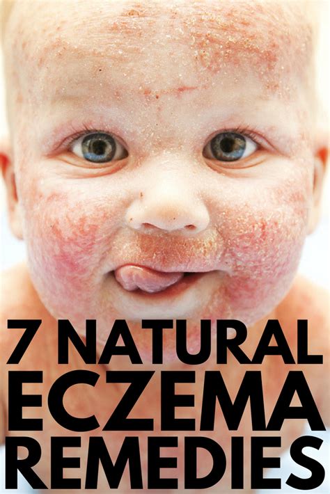 Eczema Treatment