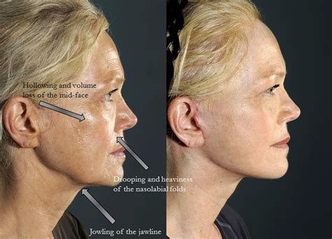 Facelift Scars: How Visible Are They? — Lara Devgan, MD, MPH, FACS