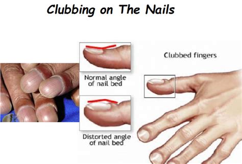 Nail Clubbing: Signs, Stages and Treatment – NailDesignCode