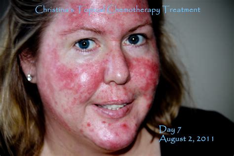 Chemo Rash On Face