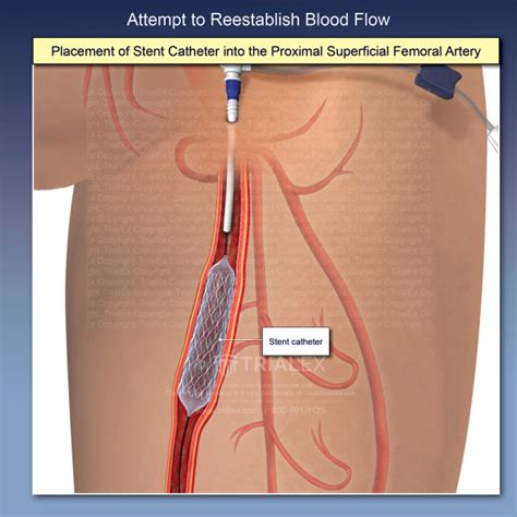 Medical Legal Exhibits - Legal Animations & Trial Graphics - Tria...