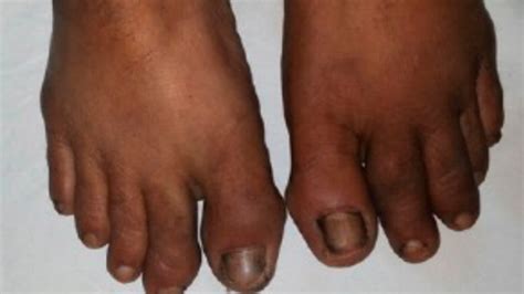 Rheumatoid Arthritis Feet Early Signs