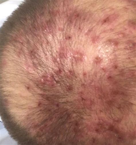 Nasty scalp folliculitis : r/Folliculitis