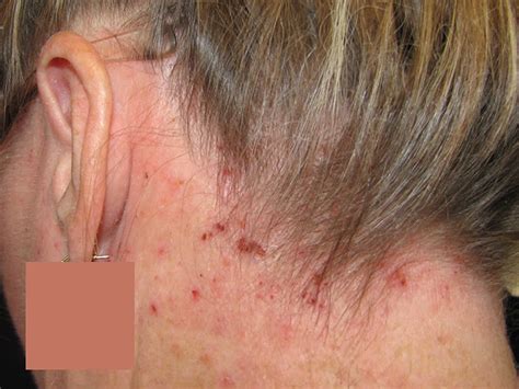 Atopic dermatitis causes, symptoms, diagnosis, treatment & prognosis