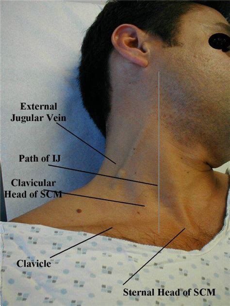 The jugular venous pulse and hepatojugular reflux examinations of ...