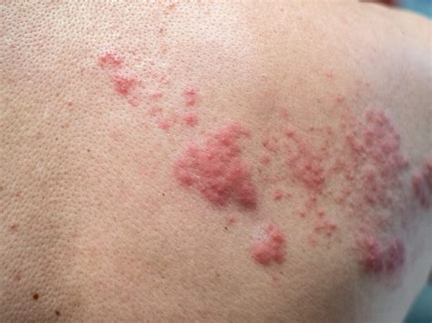 What Does A Mild Shingles Rash Look Like | Allergy Trigger