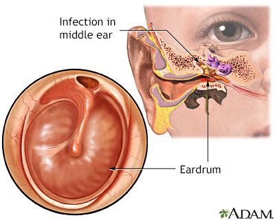 Ear infection - chronic - UF Health