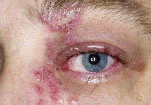 Shingles in Eye, Eyeball, Pictures, Symptoms, Without Rash, Contagious ...