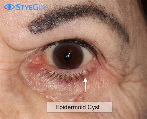 Inclusion Cysts Eyelid