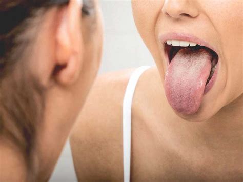 Pictures Of Early Signs Of Tongue Cancer - Infoupdate.org