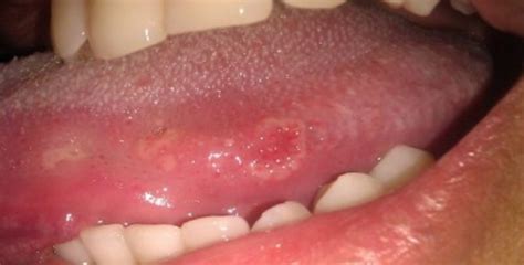 Syphilis in the oral cavity: on the lips and tongue - manifestations ...