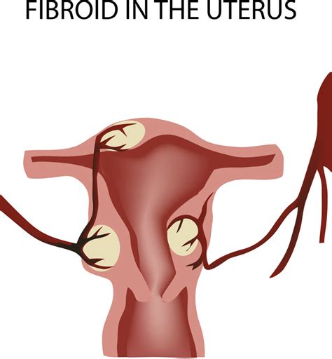 What's the Difference Between Ovarian Cysts and Uterine Fibroids ...