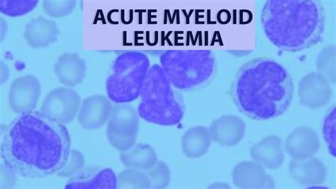 Acute Myeloid Leukemia: Overview and Treatment - CancerConnect