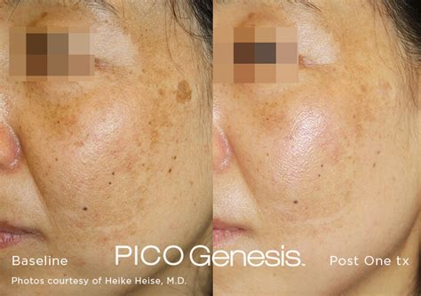 Permanent Dark Spot Removal | PICO Genesis Laser | Miami Skin Spa