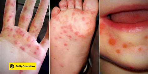 Hand-foot-and-mouth disease in 30 Iloilo towns | Daily Guardian