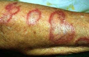 👉 Discoid Lupus - Pictures, Symptoms, Treatment, Causes (December 2021)