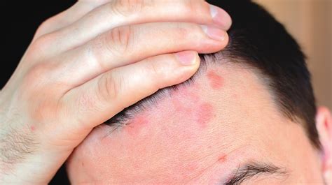 Itchy Red Rash On Scalp And Neck | Allergy Trigger