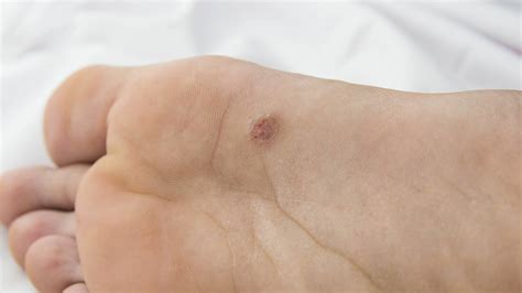 Plantar Wart Stages of Healing: A Comprehensive Guide - MyHealthGeek